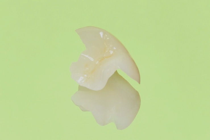 セラミックインレーの画像